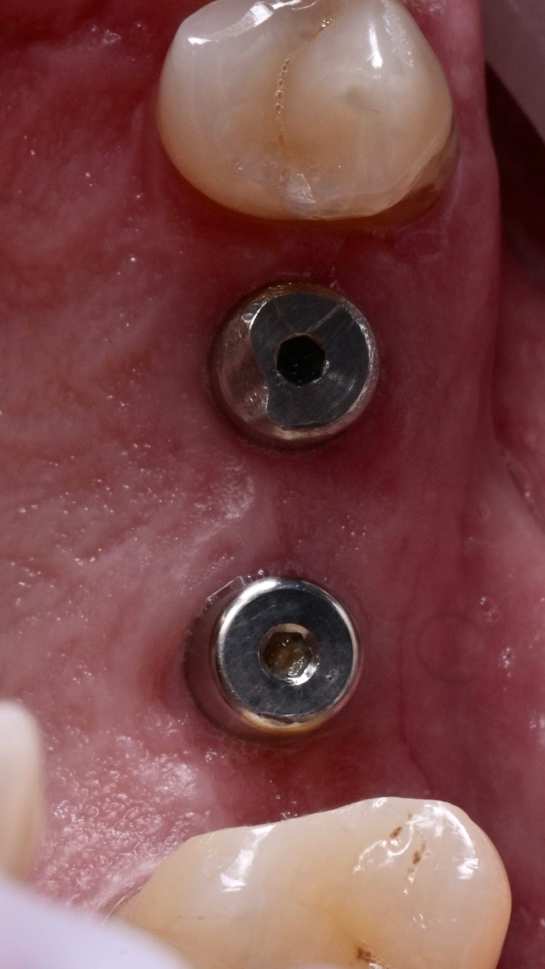 Federal-Dent — treatment 1